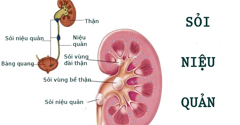 Sỏi niệu đạo, sỏi cổ bàng quang là nguyên nhân gây bí tiểu